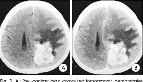 Figure 1 from Metastatic Mucinous Adenocarcinoma Mimicking Cerebral ...