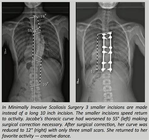 Scoliosis Treatment Options