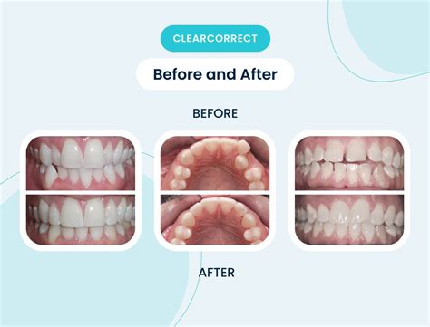 Clip On Orthodontic Dental Clinic- Braces Invisalign Studio, 52% OFF