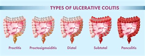 Ulcerative Colitis Treatment in Pune- Kaizen Gastro Care