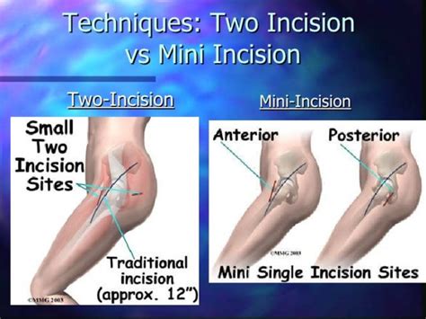 Minimally Invasive Total Hip Replacement | Orthoped