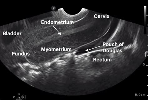 Ultrasound Evaluation Of The Uterus Radiology Key