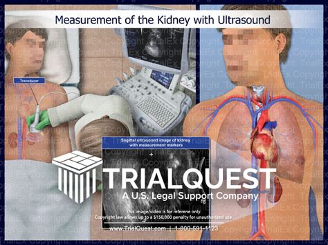 Measurement of the Kidney with Ultrasound - Trial Exhibits Inc.