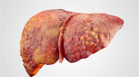 Alcoholic Cirrhosis with Ascites: A Case Report & Treatment Options ...