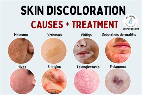 Skin Discoloration: Causes, Pictures, and Treatment