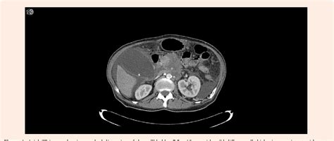 Figure 1 from Symptoms of Impending Gallbladder Perforation and Acute ...