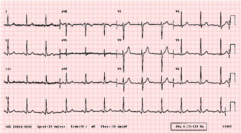 Normal Ecg Tracing