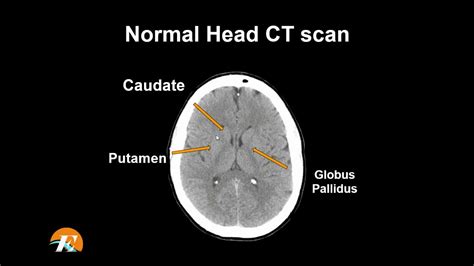 Ct Scan Brain Anatomy Anatomy Of Head Ct Scan Normal The Brain On Ct ...