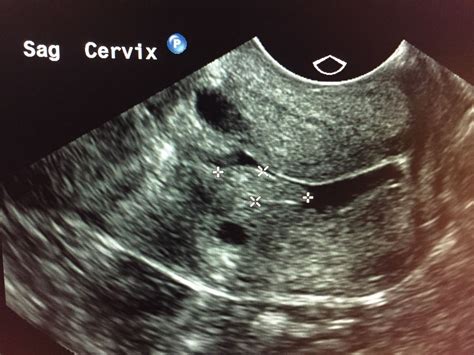 Cervical polyp on transvaginal ultrasound | Ultrasound | Pinterest ...