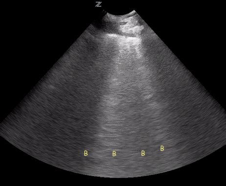 Lung ultrasound: A and B-lines – NephroPOCUS