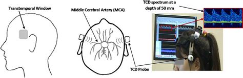 Transcranial doppler or transcranial doppler sonography