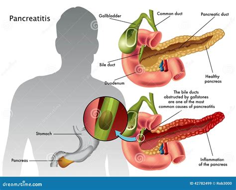 Acute Pancreatitis Infograpfic Vector Illustration | CartoonDealer.com ...