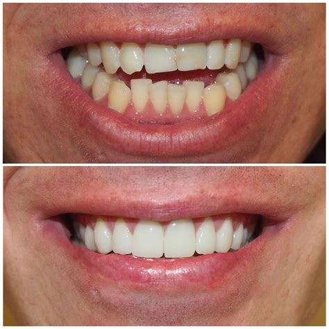 Porcelain Veneers Brisbane [Free Consult] | Smiling Dental