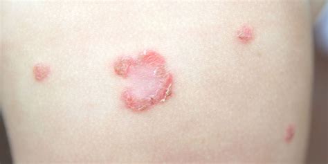 Impetigo Abdomen