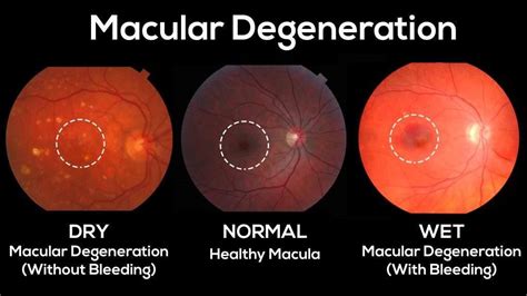 Dry vs Wet Macular Degeneration