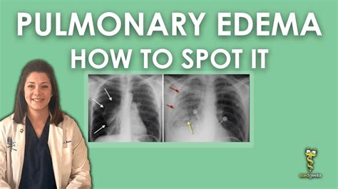 Pulmonary Edema Chest X Ray