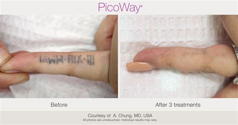 PicoWay Laser Tattoo Removal – Synergy Medical Aesthetics – Nanaimo ...