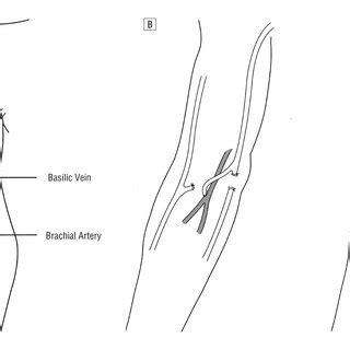 (PDF) Delayed Superficialization of Brachiobasilic Fistula: Technique ...