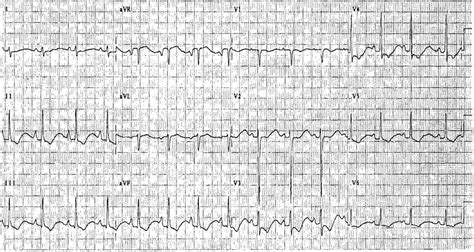 Hypokalemia ECG Changes [With Examples] - Manual of Medicine