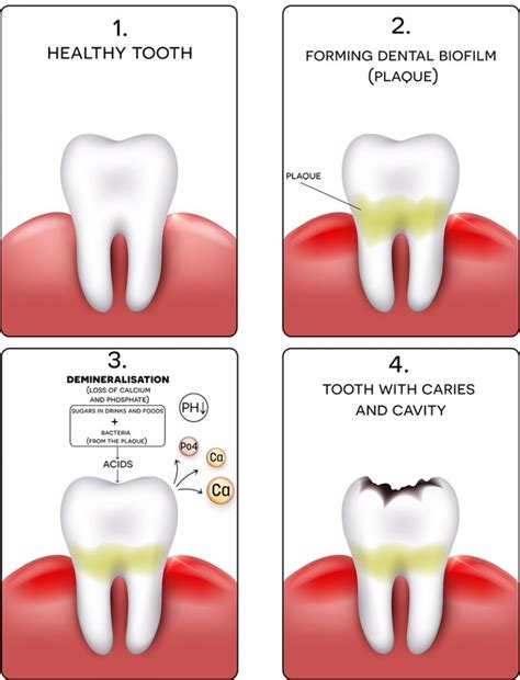 Cavities: Symptoms, Causes, and Treatment - Willow Pass Dental Care