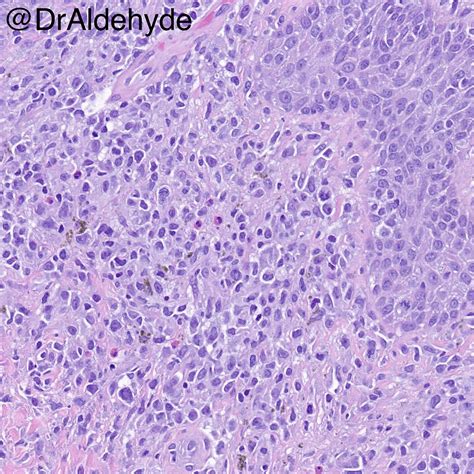 Mycosis Fungoides Histology