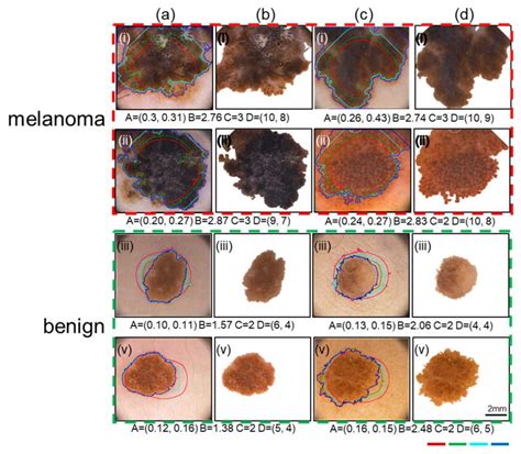 Stage 4 Melanoma Cancer