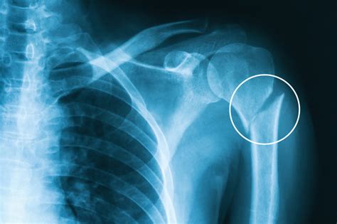 Humerus Fracture: Types, Symptoms & Treatment