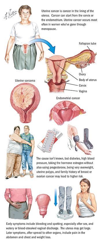 How Do You Know You Have Cancer In Your Uterus - CancerWalls