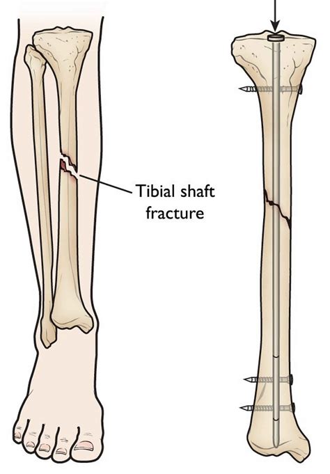 Fibula fracture - brickmyte