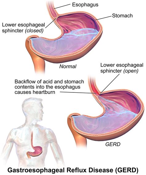 What is Heartburn or GERD? What causes GERD & how do you prevent it?