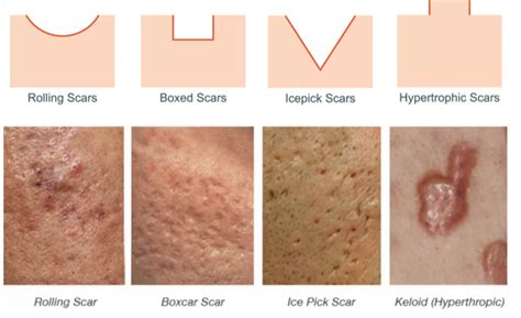 Acne Scars - PREMIER DERM MD | TREATING ACNE & SCARRING, WRINKLES, DARK ...