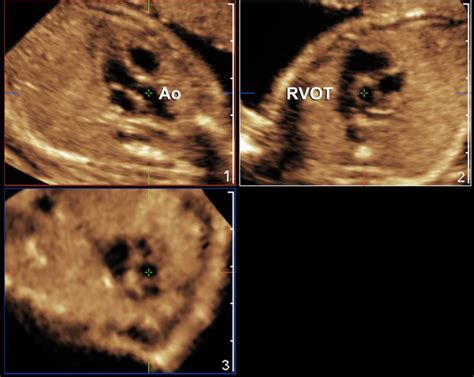 Volumetric Imaging of the Fetal Heart | Ultrasound sonography ...