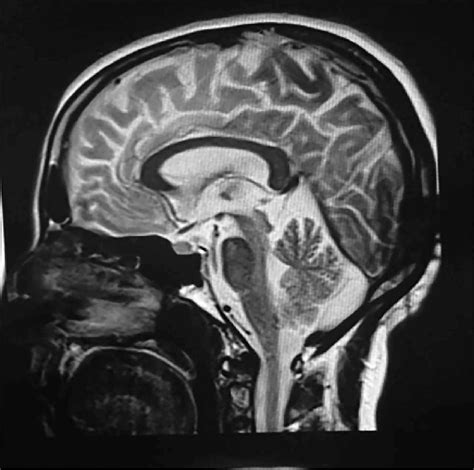 Normal Sagittal Brain Mri