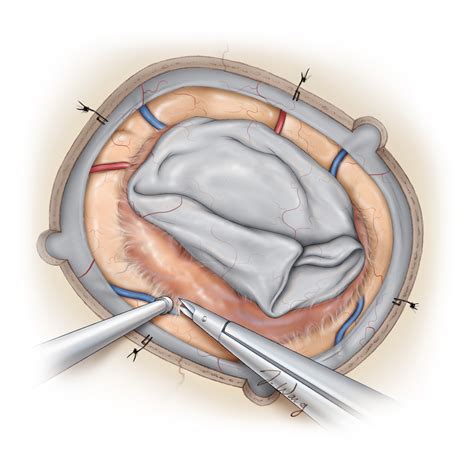 General Information for Meningiomas | Patient Resource Center | The ...