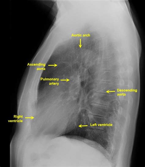 Lateral Chest Radiograph Anatomy | Normal Lateral Chest X Ray Male ...