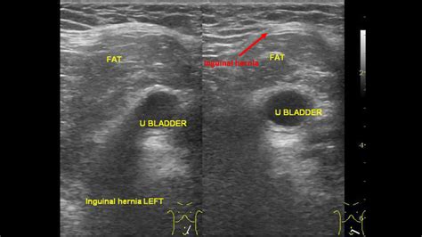 Inguinal Hernia Ultrasound Landmarks