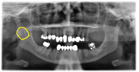 Anatomy Monday: Mandibular Foramen – Dr. G's Toothpix