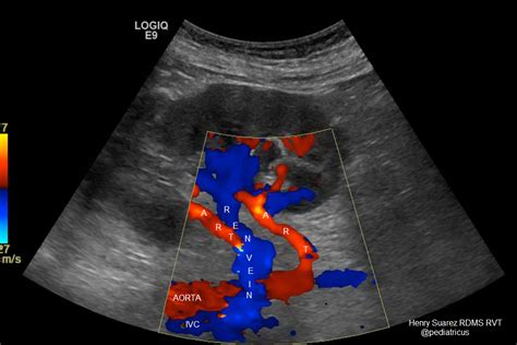 Renal Artery Doppler Ultrasound Worksheet