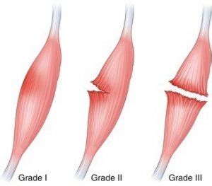 Calf Strain: Torn Calf Muscle | Phyx. Physio + Pilates