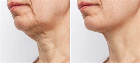 Botox For Jowls - Treatment, Before and After, Alternative, Costs