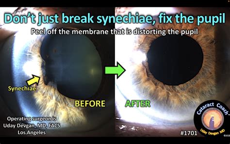 1701 peel synechiae – Cataract Coach™