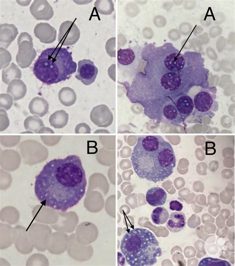 DUTCHER VERSUS RUSSELL BODIES IN PLASMA CELLS