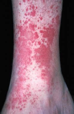 Allergic Vasculitis Rash