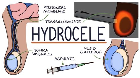 Hydrocele Treatment