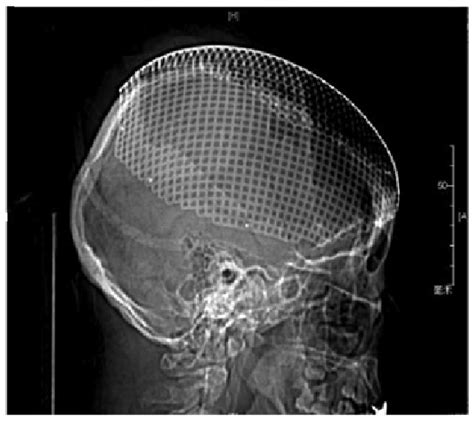 Cranioplasty with titanium mesh following the resection of the lesions ...