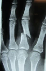 Broken Finger Treatment in Raleigh NC