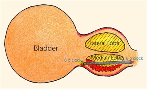 Median Lobe Prostate