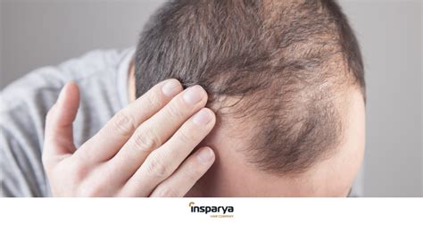 Minoxidil: what it is for and its side effects | Insparya Hair Clinic