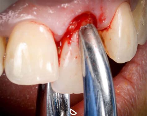 Simple Tooth Extraction in Malolos Bulacan - Dr. Keith's Dental Clinic