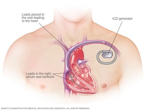 Cardiac Defibrillator